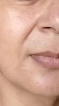 After Wart Removal result