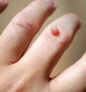 Warts on the skin caused by HPV