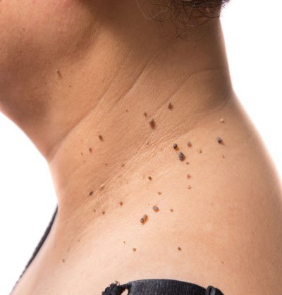 Close-up of warts on the skin treated at DTC Skin Clinic