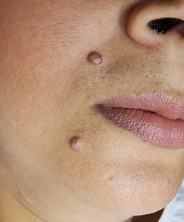Warts and Wart Removal: What You Should Know Before Treating Them